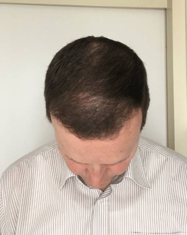 bovenaanzicht haarimplantaten na 1 maand