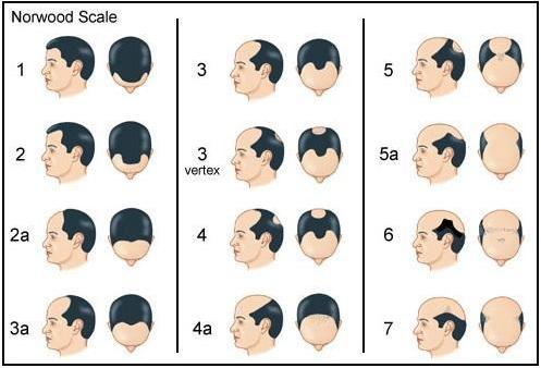  Norwood Scale - indeling van mannelijke kaalheid