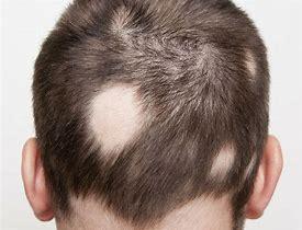 Het type haaruitval Alopecia Areata