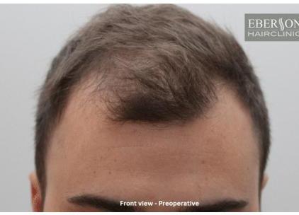 Vooraanzicht haarlijn vóór haartransplantatie