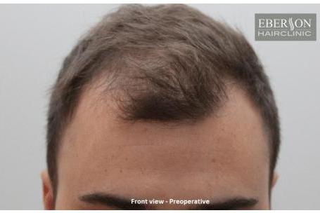 Vooraanzicht haarlijn vóór haartransplantatie